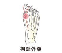 常穿高跟尖头鞋小心拇外翻，矫正鞋垫可帮助干预